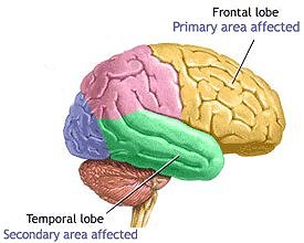 Alzheimer Google image from http://www.drkassicieh.com/images/Brain-Diagram-Alzheimers.gif