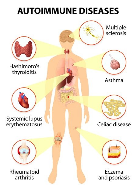  Google image from https://www.drhagmeyer.com/autoimmune-disease/