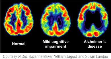 Dementia Google image from http://www.uth.tmc.edu/reynolds/images/GemsDementiaNhosp.png Courtesy of Doctors Suzanne Baker, William Jagust and Susan Landau, University of Texas Health Science in Houston TX - FDG-PET images show reduced glucose metabolism in temporal and parietal regions in Alzheimer's disease and mild cognitive impairment.