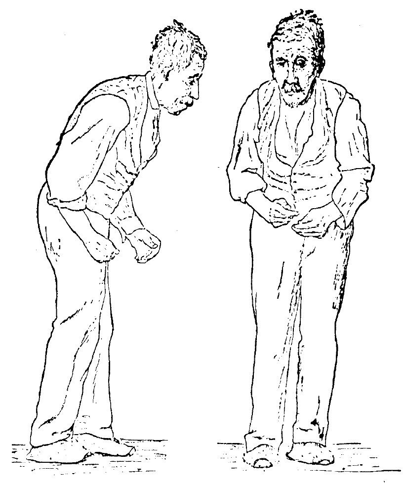 Google image from http://upload.wikimedia.org/wikipedia/commons/d/d7/Sir_William_Richard_Gowers_Parkinson_Disease_sketch_1886.jpg