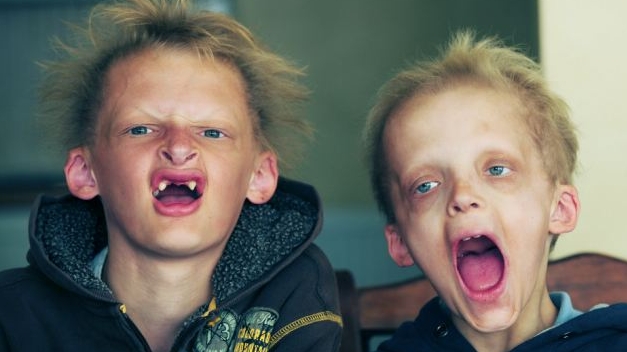 Brother Simon, 13, and George, 11, both suffer from a condition called Porphyria Google image from http://www.dailymail.co.uk/health/article-1327716/Real-life-Twilight-Cullen-brothers-rare-vampire-like-syndrome.html