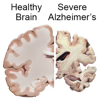 Healthy Brain, Severe Alzheimers Google image from https://medium.com/lantern-searchlight-informed-consent/memory-loss-and-alzheimers-7abef1a4d202