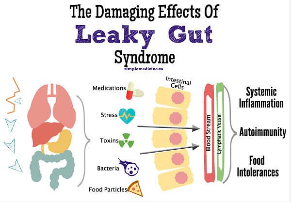 Leaky-Gut-Syndrome  Google image from Understand Leaky Gut Syndrome and 4 Steps to Reversing It by Dr. Dane Donohue, Jun 19, 2017, Chiropractor Newtown PA, Health News, Nutrition, Wellness Center Newtown https://wscenters.com/leaky-gut-syndrome/
