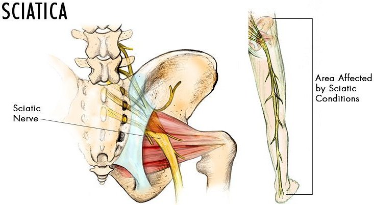 Sciatica Google image adapted from http://blog.bonati.com/wp-content/uploads/2015/01/SciaticaBonatiLicensed-1024x415.jpg