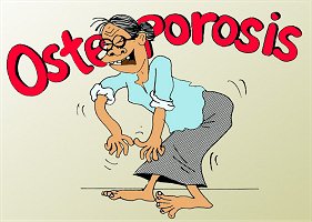 Osteoporosis Google image from http://nutriweb.org.my/nutriteen/wallpapers/osteoporosis.jpg
